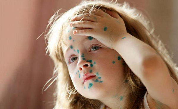 Ветряная оспа в курсе, что с «короной» Минздрав накосячил — и бесчинствует в российских регионах Ветряная оспа в курсе, что с «короной» Минздрав накосячил — и бесчинствует в российских регионах